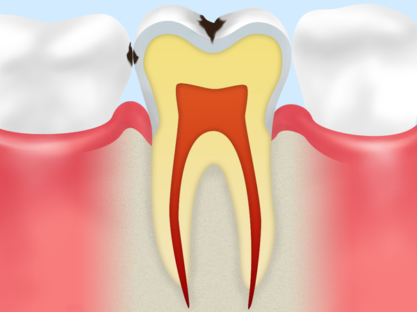 C1：初期段階の虫歯