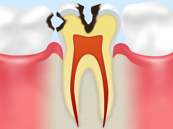 C2：冷たい物がしみる虫歯
