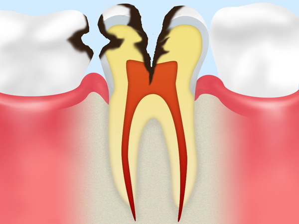 C3：痛みがある虫歯