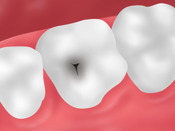 虫歯の原因について