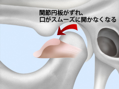 「カクカク鳴る」のは顎関節症かもしれません