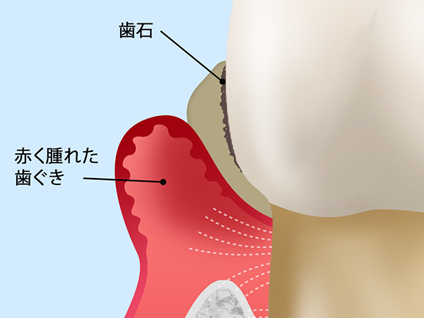 中等度